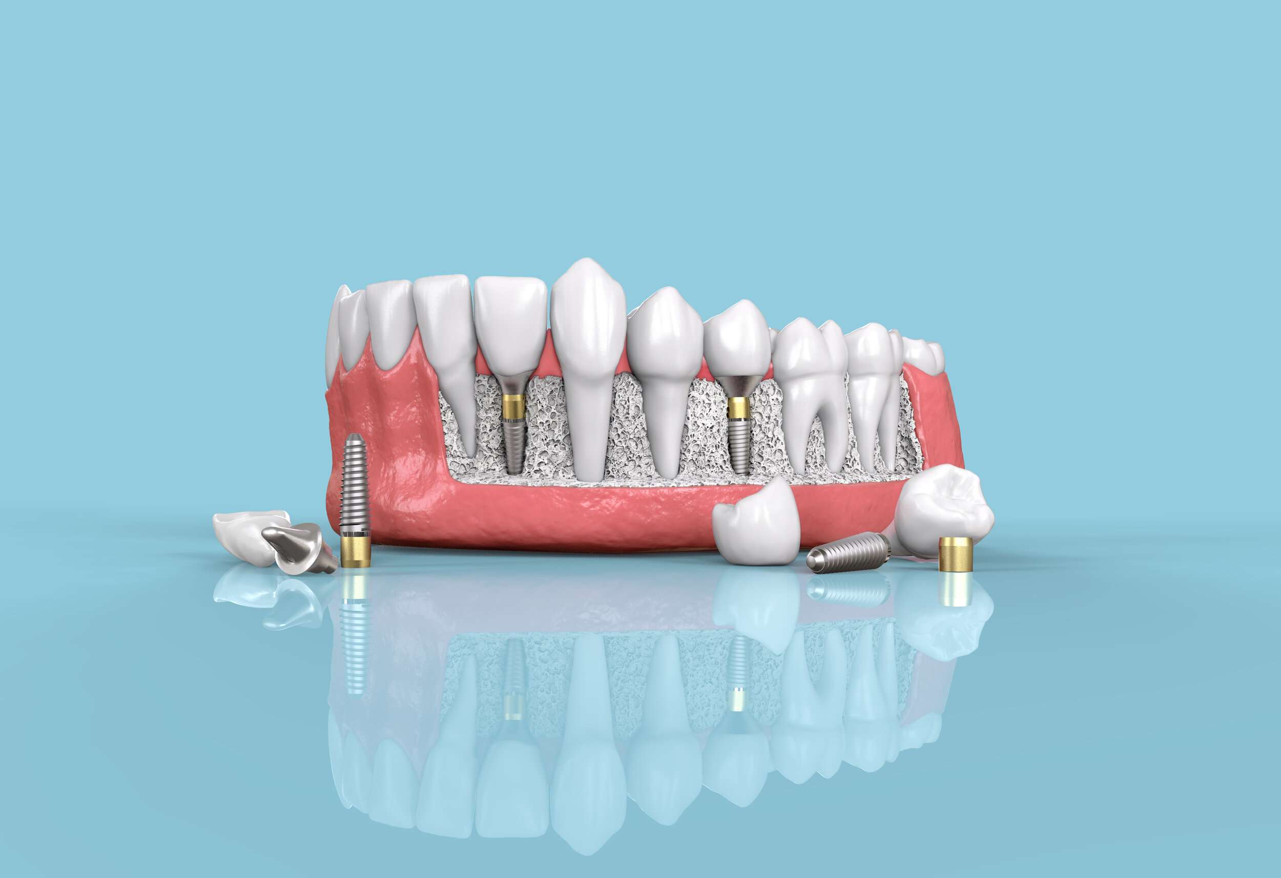 DENTAL IMPLANTS