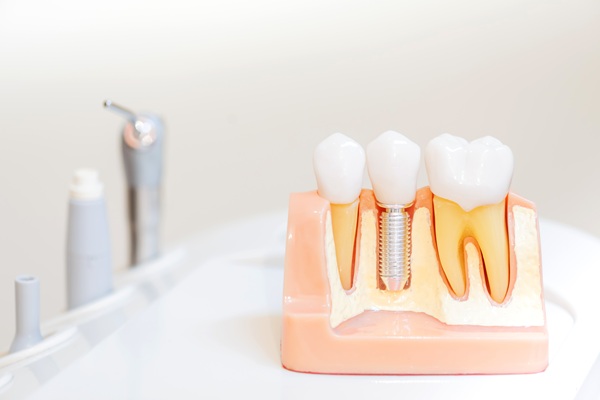 Can All My Teeth Be Replaced With Implants?